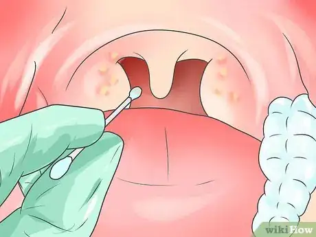 Image titled Take a Throat Culture Step 6