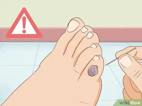 Image titled Treat a Blood Blister Step 8