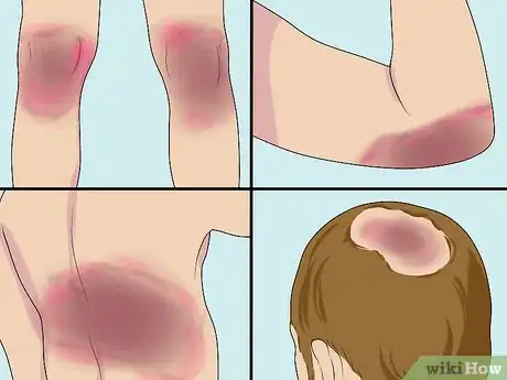 Image titled Diagnose Erythrodermic Psoriasis Step 8