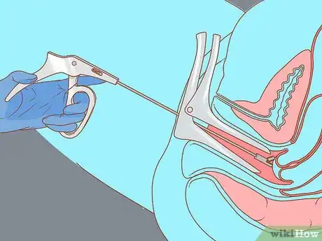 Image titled Test for HPV Step 13