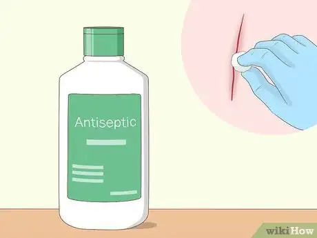 Image titled Prevent Surgical Site Infections Step 16