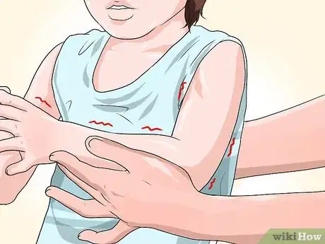 Image titled Diagnose Stiff Skin Syndrome Step 2