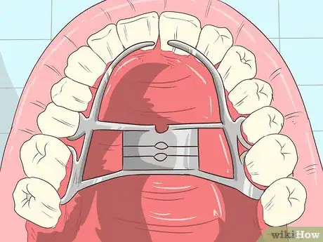 Image titled Straighten Your Teeth Without Braces Step 13