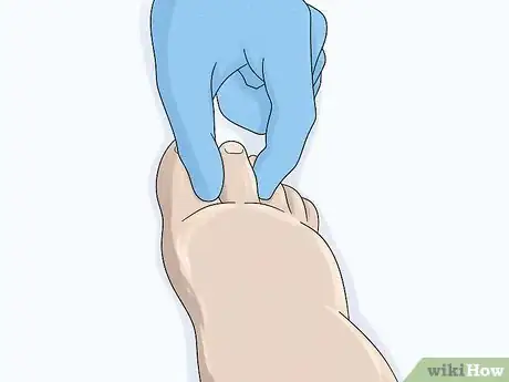 Image titled Identify Lymphedema Step 7