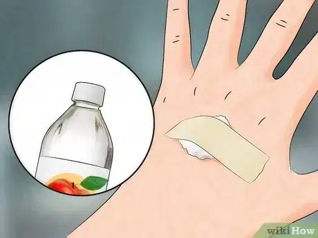 Image titled Reduce the Pain of Gnat Bites Step 3
