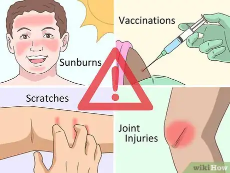 Image titled Treat Both Psoriatic Arthritis and Psoriasis Step 11