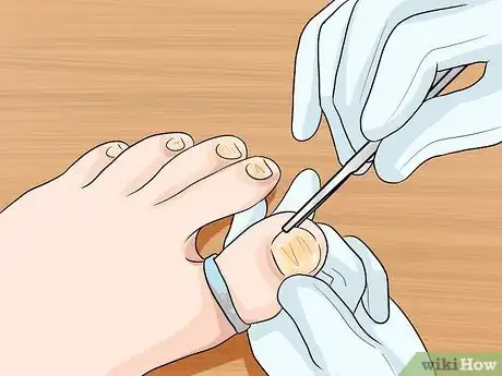 Image titled Get Rid of Yellow Toenails Step 5