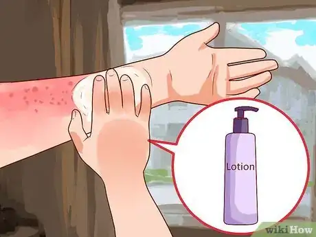 Image titled Relieve Discomfort Caused by Eczema Step 2