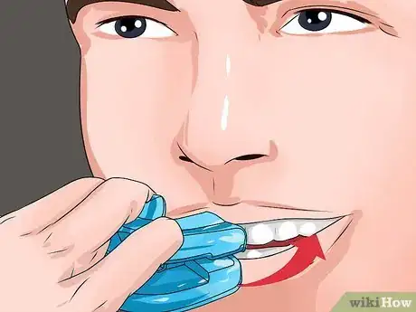 Image titled Stop Snoring by Using an Anti Snoring Mouthpiece Step 14