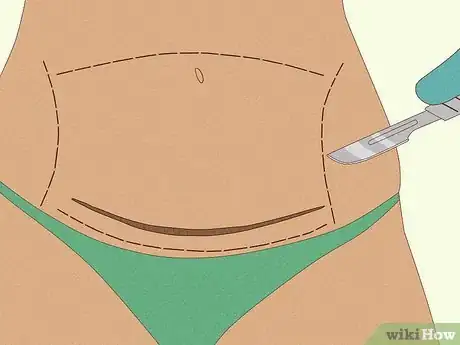 Image titled Lighten a C‐Section Scar Step 10