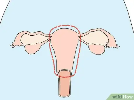 Image titled Have Essure Sterilization Reversed Step 7