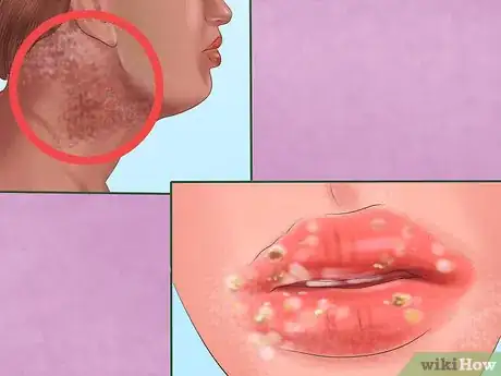 Image titled Spot Signs of Inhalant Abuse Step 5