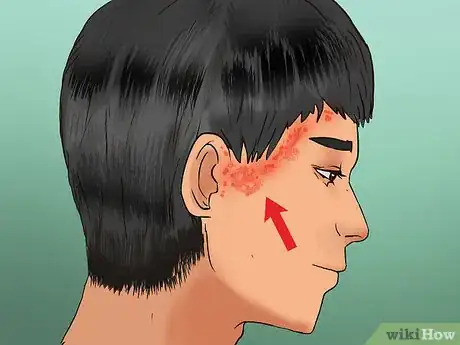 Image titled Stop Helmet Itch Step 7