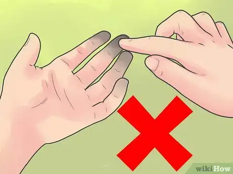 Image titled Heal Skin Damage from Frostbite Step 8