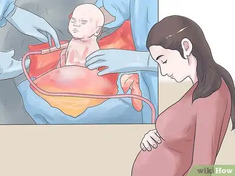 Image titled Prepare for a Cesarean Section Step 14