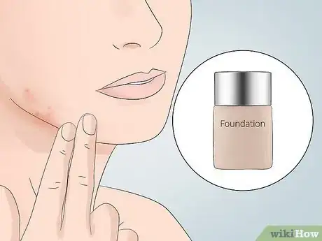 Image titled Cover Inflamed Pimples Step 4