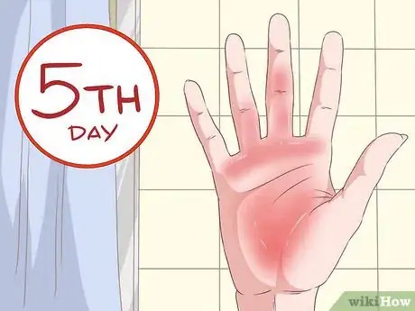 Image titled Recognize Marburg Hemorrhagic Fever Symptoms Step 3