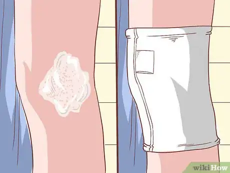 Image titled Handle an Eczema Flare Up Step 11