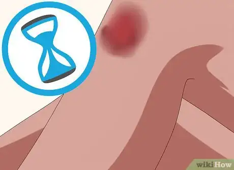 Image titled Heal a Bruise Step 2