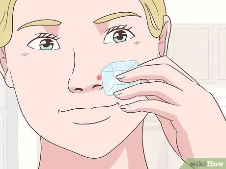 Image titled Get Rid of a Pimple Step 9