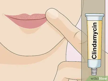 Image titled Get Rid of Fordyce Spots Step 4