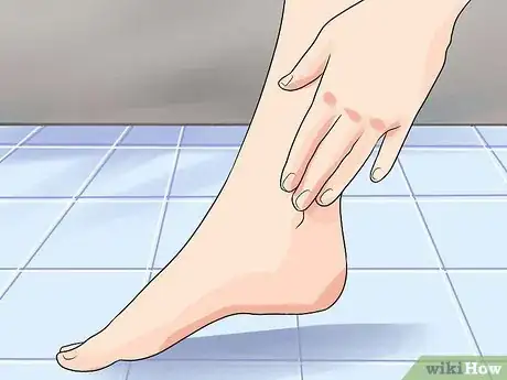 Image titled Identify Achilles Tendinitis Step 3