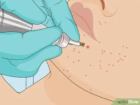 Image titled Get Rid of Fordyce Spots Step 8