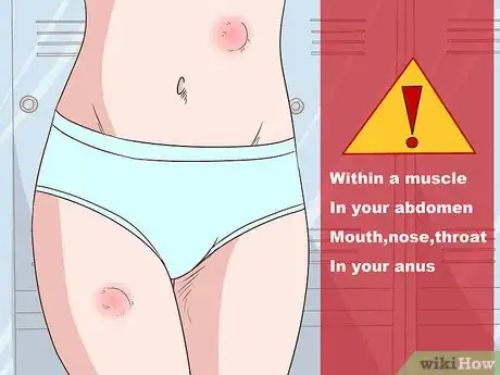 Image titled Diagnose Sarcoma Step 1