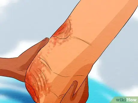 Image titled Care for Your Prosthesis Step 15