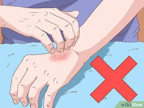 Image titled Handle an Eczema Flare Up Step 12