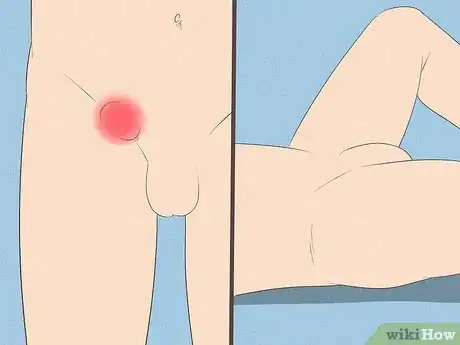 Image titled Treat Inguinal Hernia Step 5