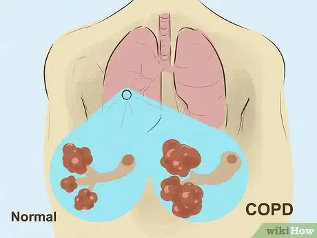 Image titled Diagnose Lung Hyperinflation Step 8