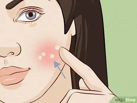 Image titled Reduce Acne Pain Step 4