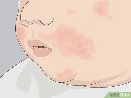 Image titled Treat Your Baby's Eczema Step 1