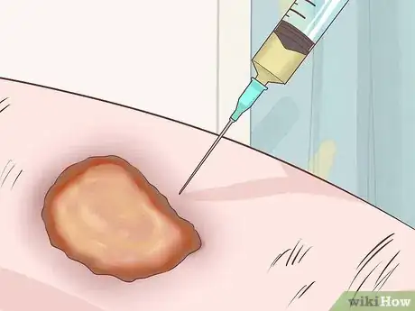 Image titled Handle a Rheumatoid Arthritis Skin Problem Step 14