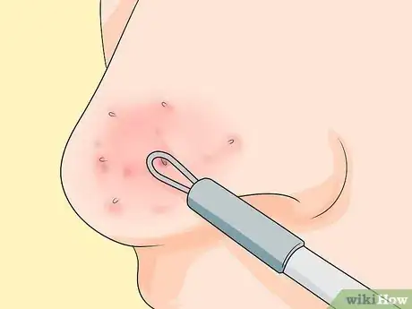 Image titled Prevent Blackheads Step 10