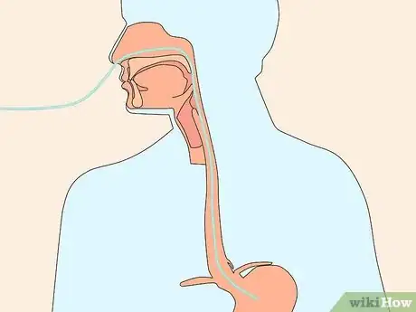 Image titled Diagnose Esophageal Diverticulum Step 10