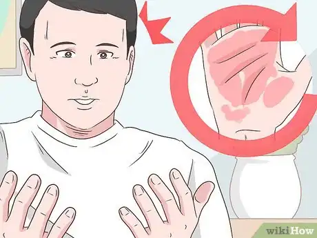 Image titled Achieve Psoriasis Remission Step 11