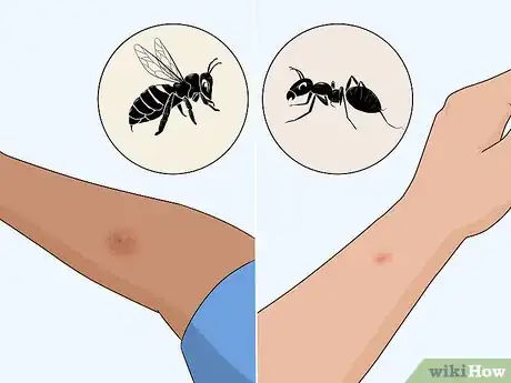 Image titled Treat Insect Bites in Toddlers Step 10