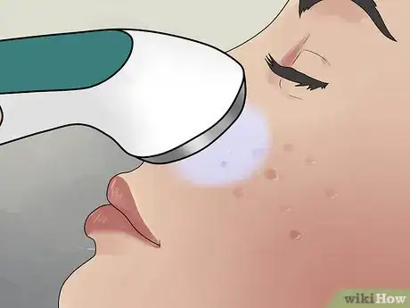 Image titled Get Rid of Cystic Acne Scars Step 11