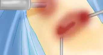 Prevent Kidney Stones from Recurring