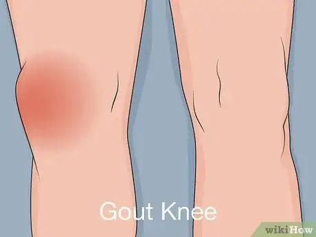 Image titled Diagnose and Treat a Tibial Plateau Fracture Step 04