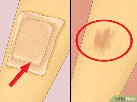 Image titled Care for Minor Abrasions and Scratches Step 6