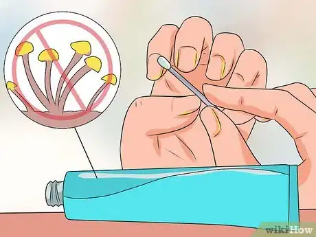 Image titled Cure Nail Fungus Step 7