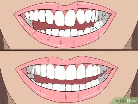 Image titled Straighten Your Teeth Without Braces Step 16
