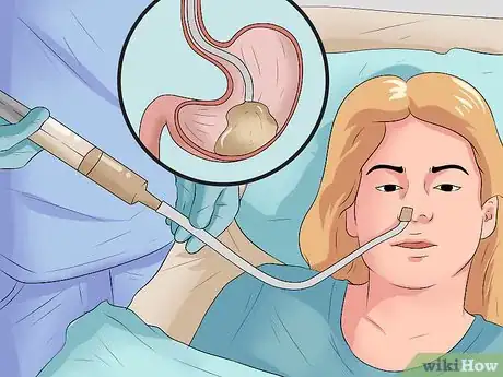 Image titled Test for Upper Gastrointestinal Bleeding Step 6