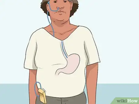 Image titled Diagnose Esophageal Diverticulum Step 11