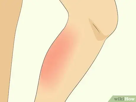 Image titled Treat Hypocalcemia Step 10