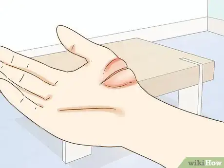 Image titled Heal Cuts Step 9