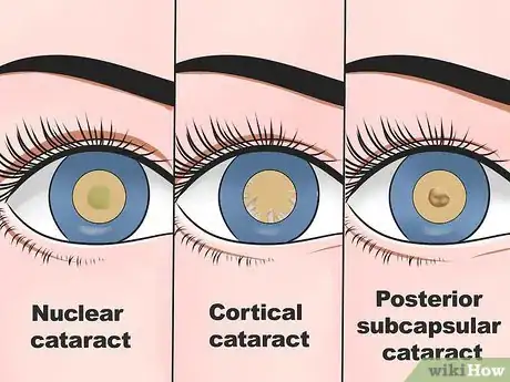 Image titled Prevent Development of Cataracts Step 11